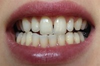 Izbjeljivanje zuba-poslije 1